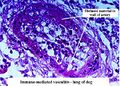 Fibrinoid degeneration immune mediated vasculitis.jpg