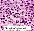 Langhans giant cell.jpg