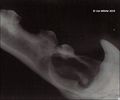 Dentigerous cyst radiograph.jpg