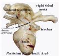 Persistent right aortic arch.jpg