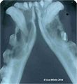 Dentigerous cyst radiograph 2.jpg