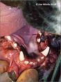 Dentigerous cyst.jpg