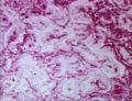 Alveolar cell carcinoma.jpg