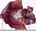 Intestinal adenocarcinoma lymphatic spread.jpg