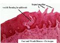 Hydropic degeneration foot and mouth ox tongue histo 1.jpg