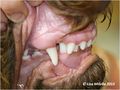Canine tooth malocclusion.jpg