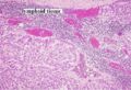 Adenocarcinoma metastasis to lymph node.jpg