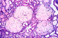 Amyloidosis histology.jpg