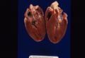 Hypertrophic cardiomyopathy.jpg