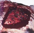 Haemangioscarcoma lung metastases.jpg