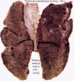 Melanoma metastases dog lung.jpg
